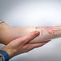 Understanding the Severity of Second-Degree Burns