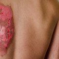 The Most Critical Issues with Third-Degree Burn Patients